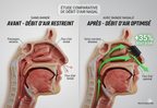Boostez votre respiration – Bandes nasales performance